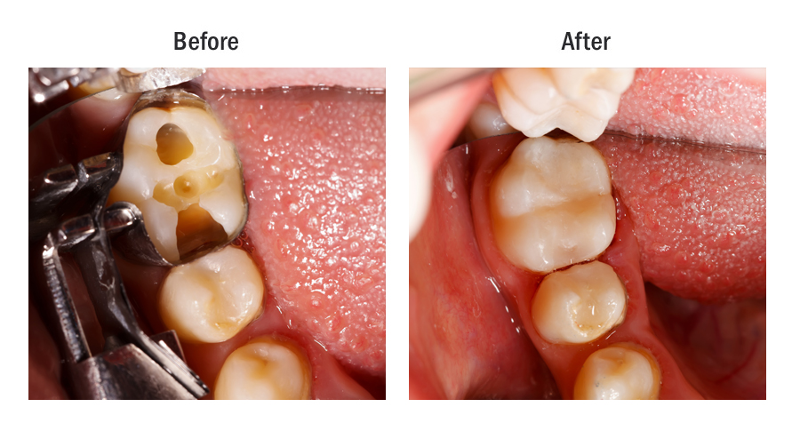 What is the Difference Between White Fillings and Silver Fillings - Resin