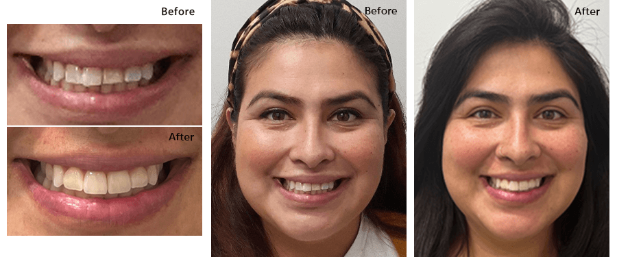 Invisalign Before and After  Dental Treatment Before and After Photos